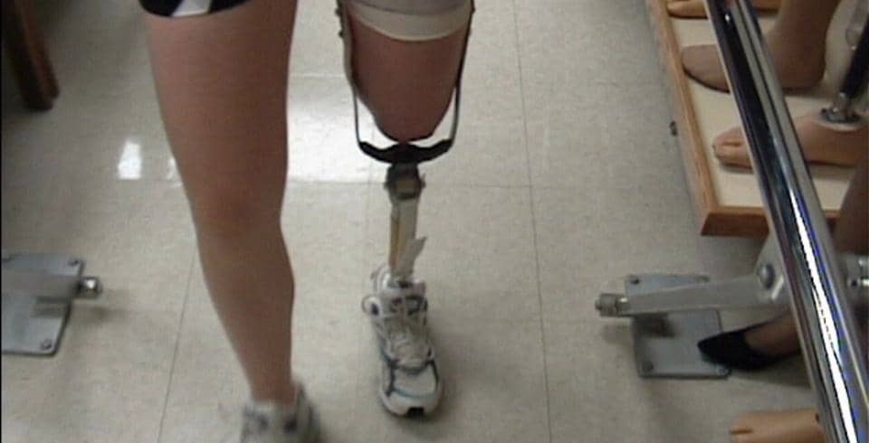 amputee phantom pain management amputee phantom pain management