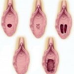 The Hymen: A Membrane Widely Misunderstood