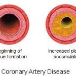 Coronary Artery Disease