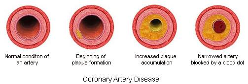 Coronary Artery Disease