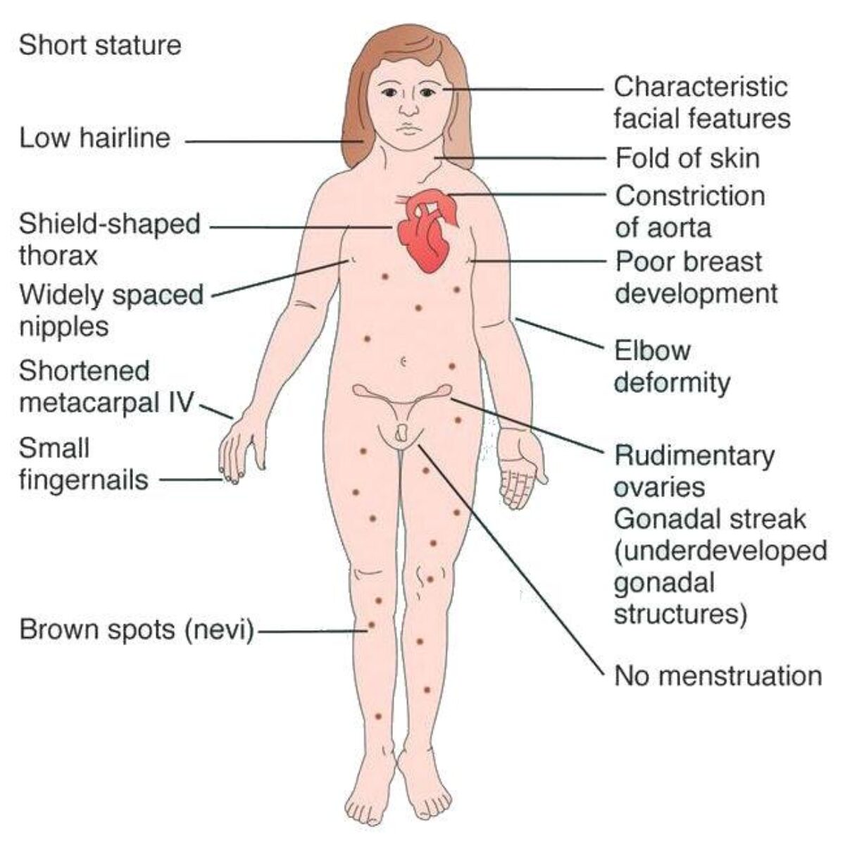 mosaic turner syndrome symptoms - looklux.ru.