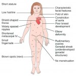 Nursing Guide: Turner Syndrome
