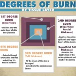 Infographic: Degrees of burn by tissue layers
