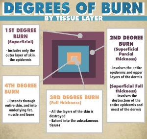 Infographic: Degrees of burn by tissue layers