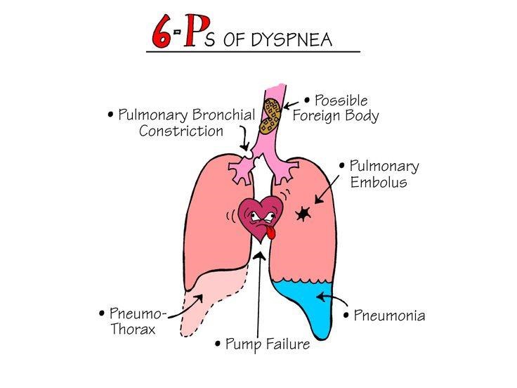 Nursing Mnemonics: 6 P's of Dyspnea