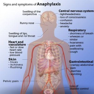 Signs and Symptoms of Anaphylaxis