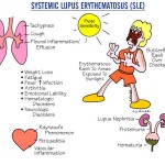 Nursing Guide: Systemic lupus erythematosus (SLE)