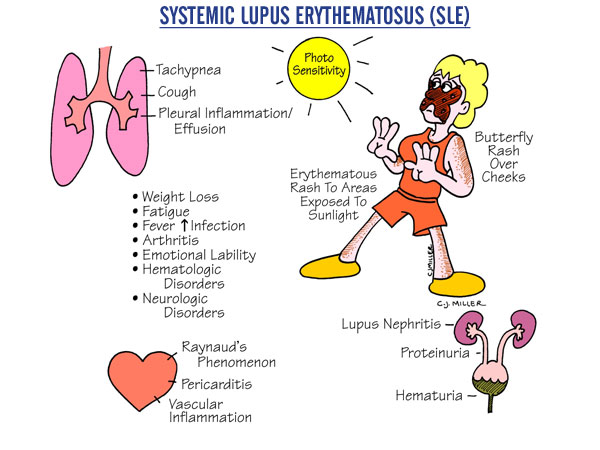 Nursing Guide: Systemic lupus erythematosus (SLE)
