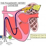 Pulmonary artery catheter Intervention