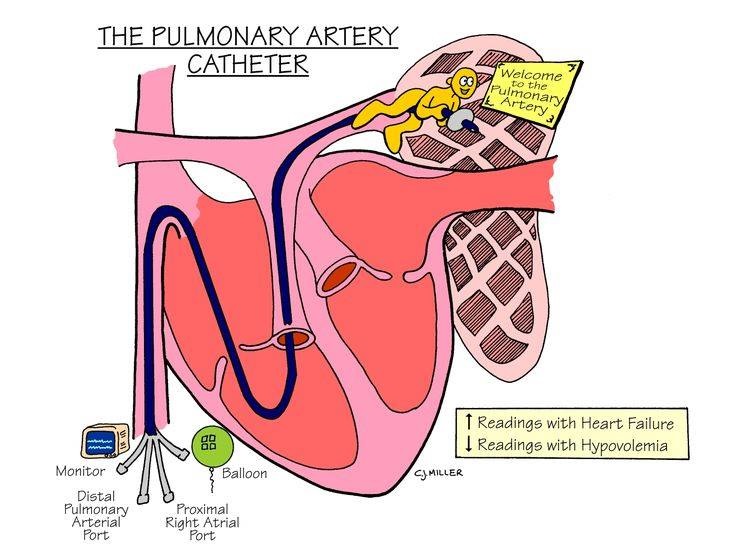 Pulmonary artery catheter Intervention