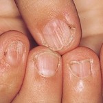 Signs Your Body has Iron Deficiency