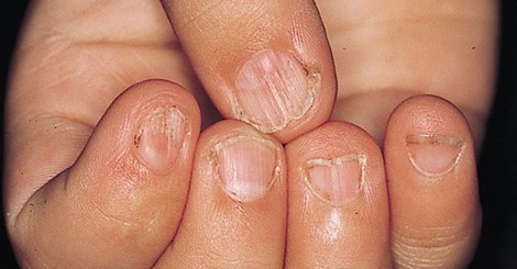 Signs Your Body has Iron Deficiency