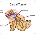 Nursing Info: Carpal Tunnel Syndrome