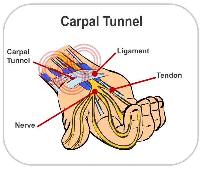 Nursing Info: Carpal Tunnel Syndrome