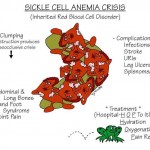 Nursing Mnemonics: Sickle Cell Anemia Crisis