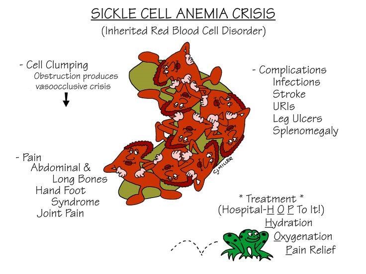Nursing Mnemonics: Sickle Cell Anemia Crisis