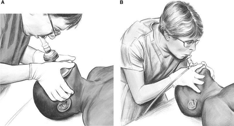 Mouth-to-Mask Cephalic Technique