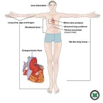 Nursing Study: Marfan’s Syndrome
