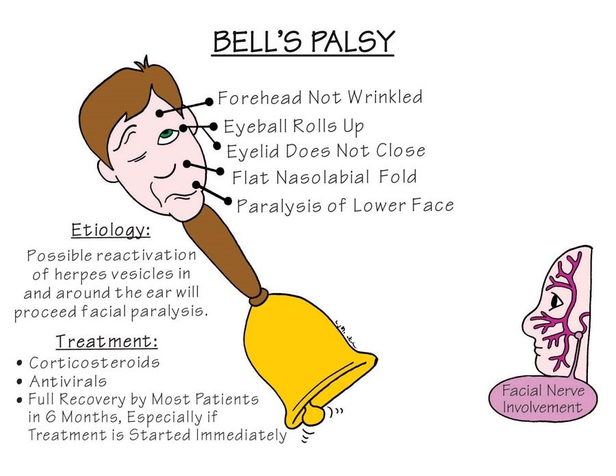 Nursing Mnemonics: Bells Palsy