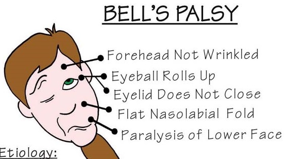 Nursing Mnemonics: Bells Palsy