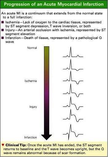 Nursing Study Progression of an Acute Myocardial Infarction