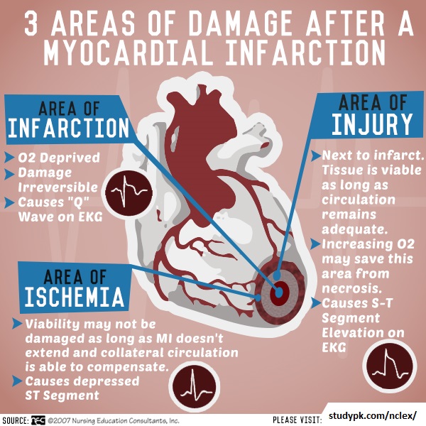 Nursing Infographics: Areas of Damage after Myocardial Infarction