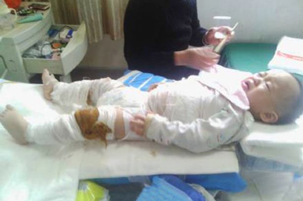 NCLEX Practice Questions: Pediatric Burn Care