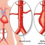 NCLEX Practice Question: Postoperative Positioning for an Abdominal Aortic Aneurysm