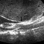 Budd–Chiari syndrome ultrasound