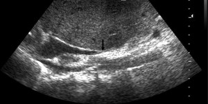 Budd–Chiari syndrome ultrasound