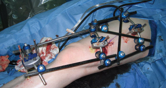 NCLEX Practice Quiz: Complications of Fractured Right Femur