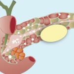 NCLEX Practice Questions to Test Your Knowledge of Chronic Pancreatitis