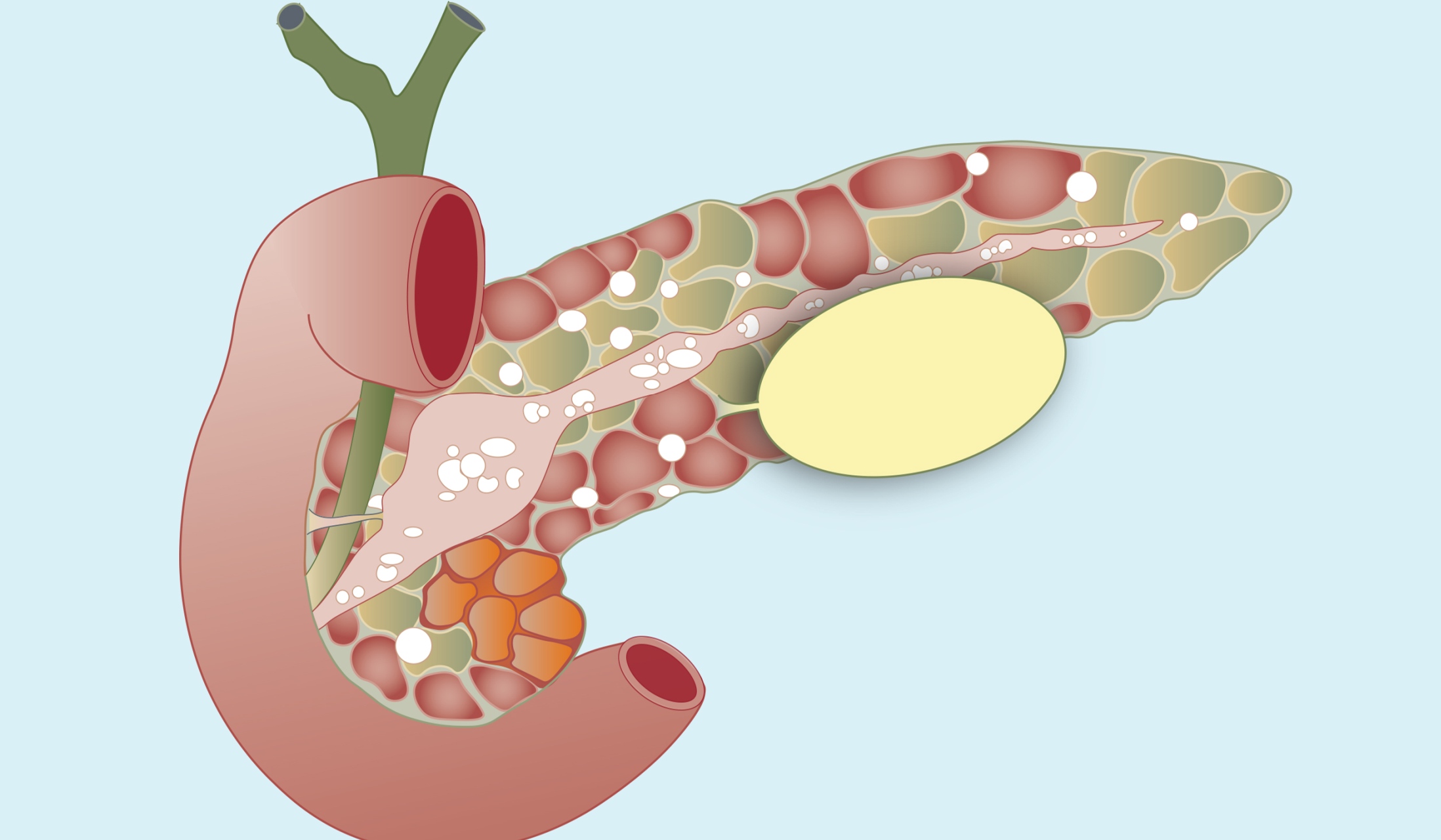 NCLEX Practice Questions: Chronic Pancreatitis Teaching