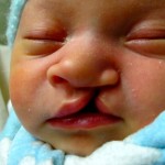 Postoperative Care for Infants with Cleft Lip Surgery