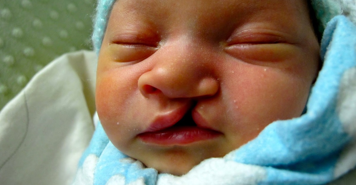 Next Generation NCLEX Practice Question: Cleft Lip Surgery