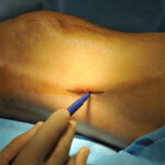 femoral-popliteal bypass graft