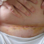abdominal hysterectomy scar