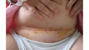 abdominal hysterectomy scar