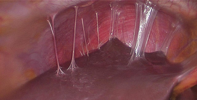 Fitz-Hugh–Curtis syndrome is described as: