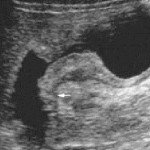 gastric cancer ultrasound
