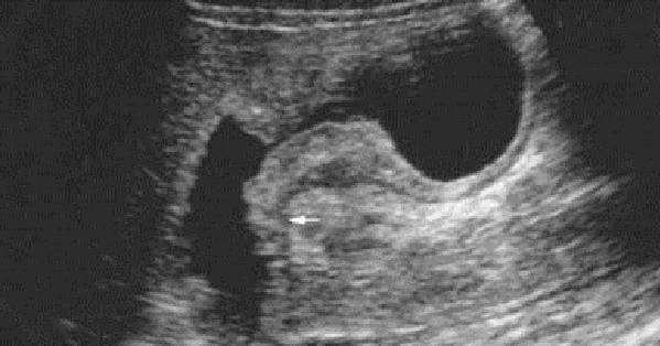 gastric cancer ultrasound