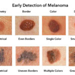 how to identify melanoma