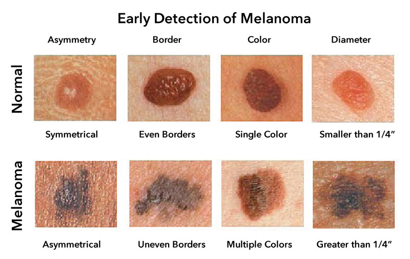 how to identify melanoma