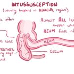 Postoperative Feeding for Infants with Intussusception