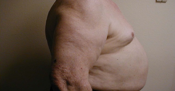 Barrel chest
