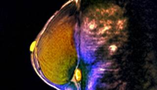 An abbreviated magnetic resonance imaging protocol can exclude malignancy in women with suspicious X-ray mammography screening.