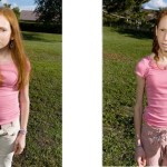 Bulimia Nervosa: Before and After