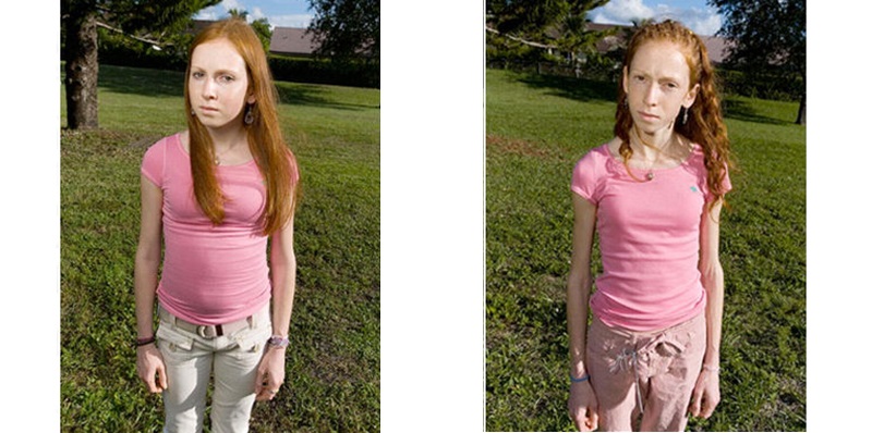 Bulimia Nervosa: Before and After