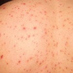 Chicken Pox