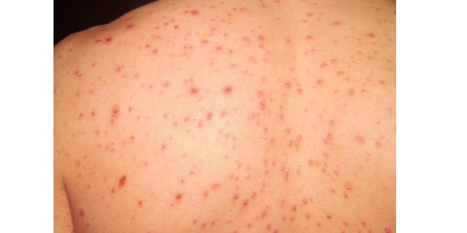 Chicken Pox